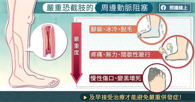 严重恐截肢的周边动脉阻塞。(图/照护线上提供)