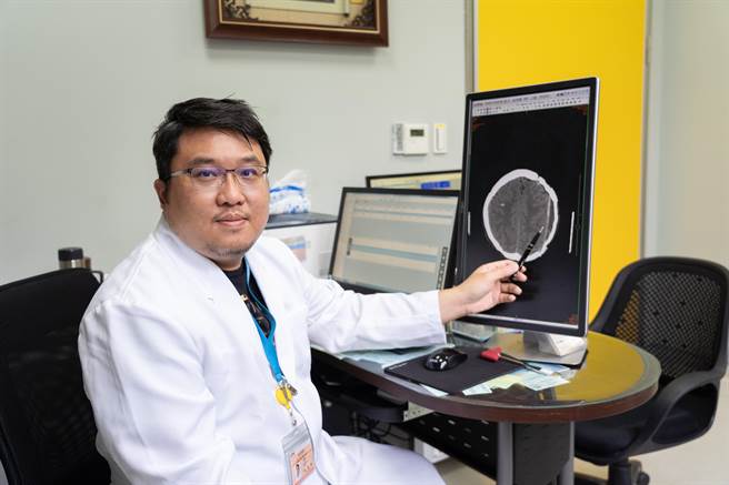 翁护理师说之前在外院手术时1／3的头盖骨用钛合金修復，但术后一直感觉左侧头部凹凸不平且疤痕很大，头髮都无法掩盖。（长安医院提供／冯惠宜台中传真）