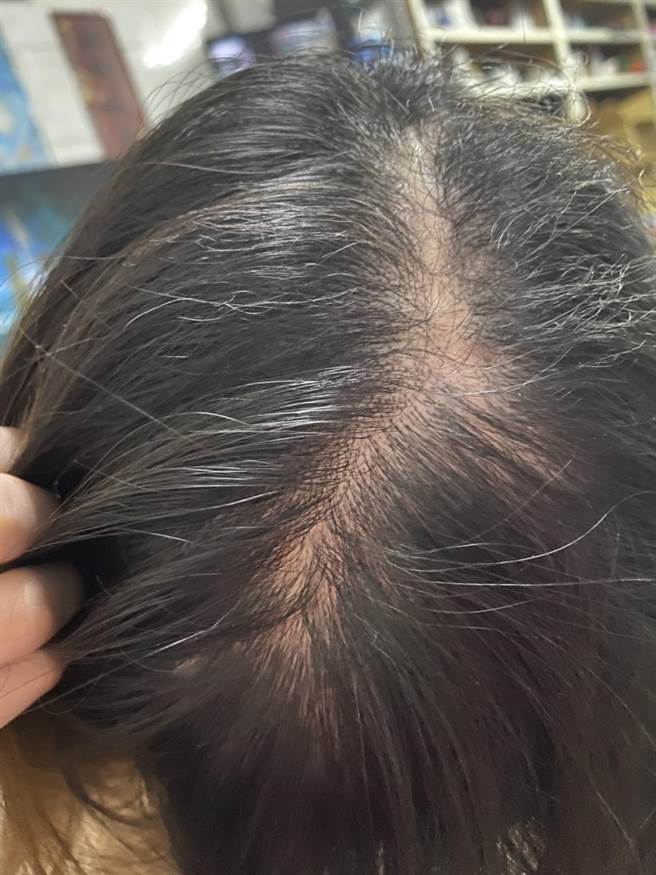 这次手术医师使用3D钛合金塑形人工头盖骨将左侧1／2头盖骨重新替换，将两边头盖骨对齐及疤痕修整，让疤痕变小了。（长安医院提供／冯惠宜台中传真）