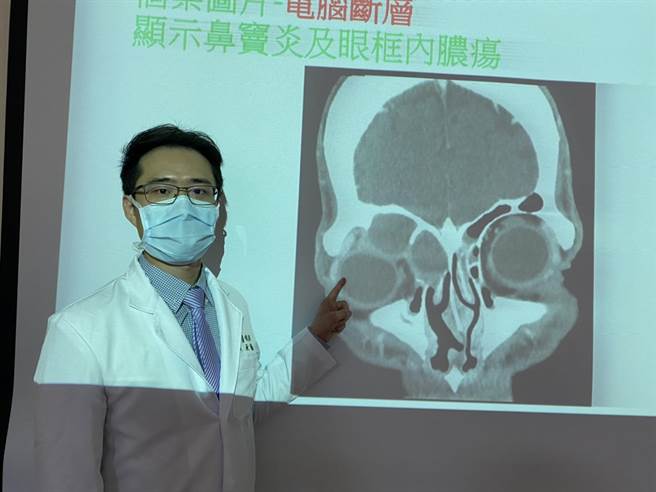 中山附医耳鼻喉头颈外科医师黄承桢表示，电脑断层检查显示，患者右侧鼻窦严重发炎外，鼻息肉已将其右眼挤压位移。（冯惠宜摄）