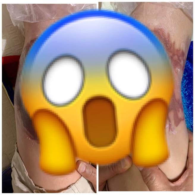 一名女網友發文表示，婆婆竟聽信朋友的話，在腳上亂敷偏方，導致嚴重灼傷，讓她相當無奈。(圖取自爆廢公社/合成圖)