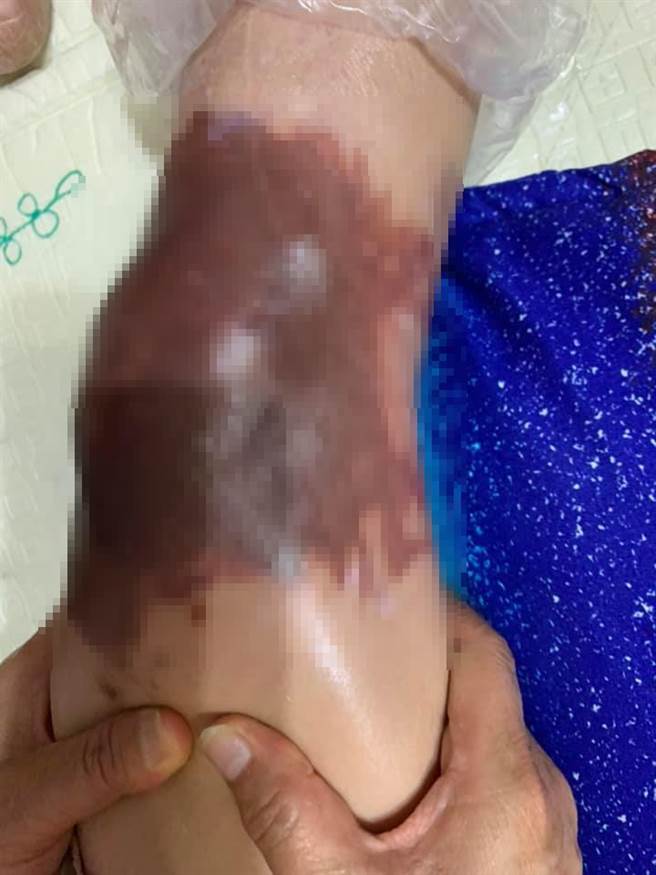 深色處都是因為敷偏方而造成的灼傷，但婆婆堅持不看醫生，讓原po很頭痛。(圖取自爆廢公社)