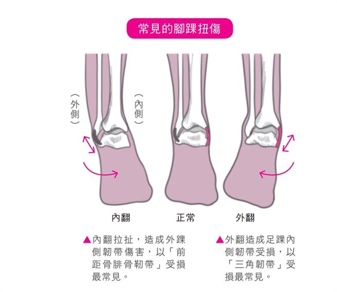 最容易扭傷的關節是足踝翻腳刀 骨科醫師公開保養之道 健康 中時新聞網