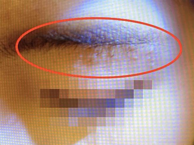 台中市20多歲OL日前紋眉，在眉毛及頸部長出50多顆小肉芽。（翻攝照片／張妍溱台中傳真）