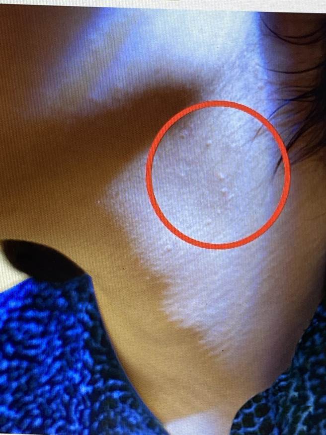 台中市20多歲OL日前紋眉，在眉毛及頸部長出50多顆小肉芽。（翻攝照片／張妍溱台中傳真）