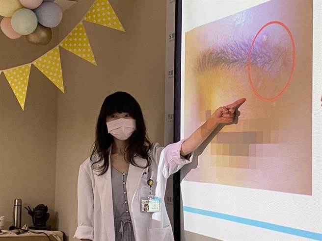 茂盛醫院皮膚科醫師鍾佩宜表示，因患者眉毛處原有傷口，紋眉器具深入真皮層時，可能感染具傳染力的病毒疣中的「扁平疣」。（張妍溱攝）