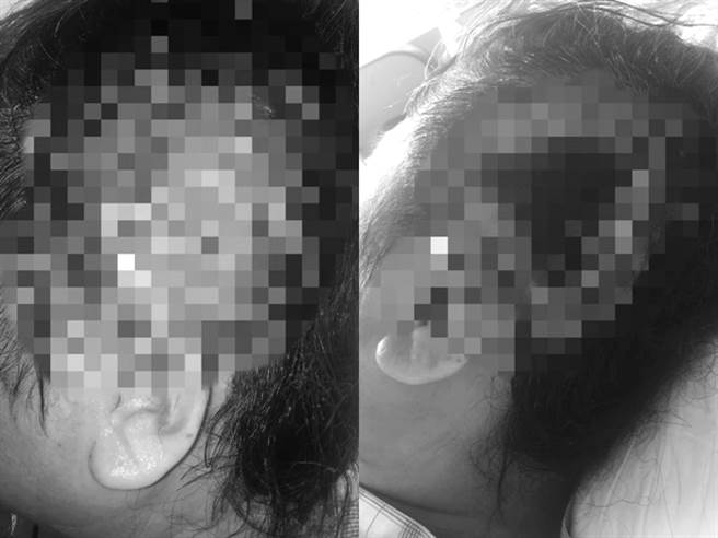 女子烫髮过程竟导致她的头皮3度烫伤，住院开刀进行多次清创手术，术后耳朵甚至缺了一角，还要进行要价16万的植髮。（图／翻摄自脸书「爆怨2公社」）