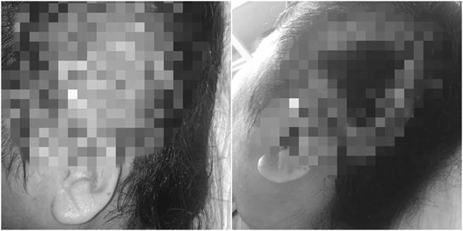 高雄一间美髮院，向客人推荐「电锅烫」后，却造成对方三度灼伤，耳朵不仅缺一块，连头皮都已烫熟。（图／翻摄自爆怨2公社）