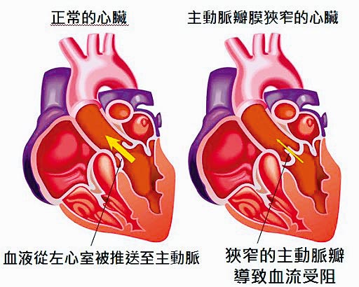主动脉瓣狭窄若轻忽不治疗，5年内的死亡率高达50%。（台安医院提供）