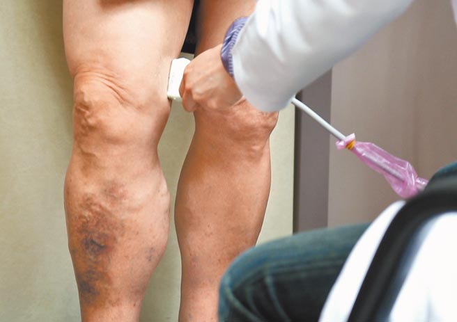 医师利用超音波确认问题的静脉所在 。（长庚医院提供）