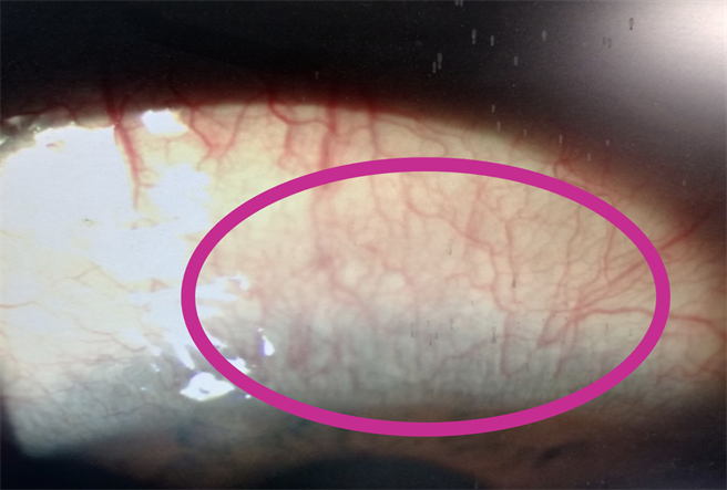 眼科医师洪启庭指出，左眼上方的球结膜出现明显的充血，且结膜(白色) 与角膜(黑色)中间交界区域有结膜血管长入形成血管翳，会产生发炎与充血的现象。（洪启庭提供）