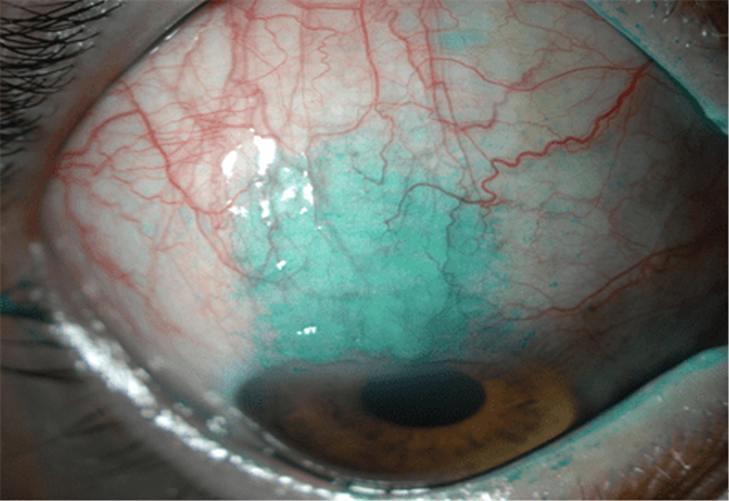 眼科医师洪启庭指出，右眼上方的球结膜以lisassamine染色，呈现淡绿色的区域，代表此处结膜上皮细胞被破坏。另外大量的扩张血管，使病人成为类似「红眼症」的表现。（洪启庭提供）