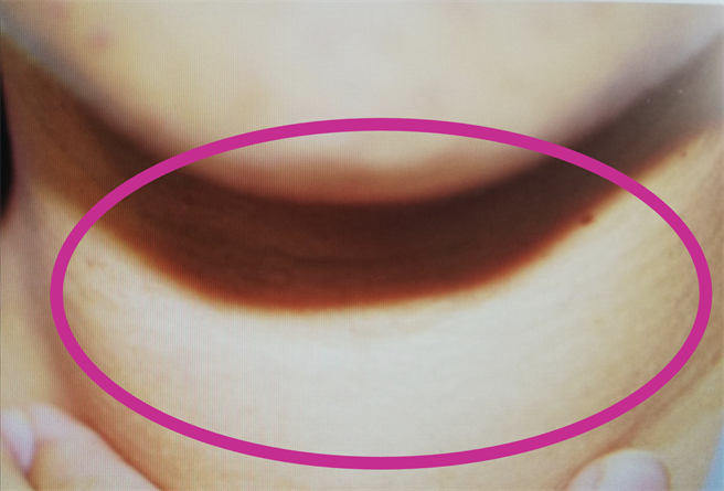 眼科医师洪启庭指出，可见本案例的SLK患者变粗的脖子，在检查时可摸到甲状腺结节，此患者最后演变成甲状腺癌。（洪启庭提供）