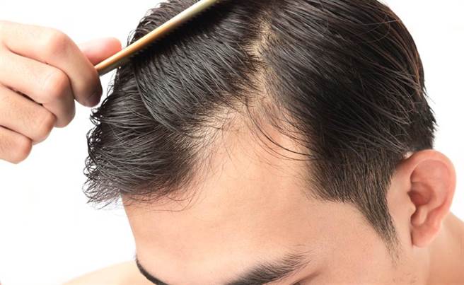 頭皮老化有5種成因，專家教你3大對策遠離禿頭。(示意圖/Shutterstock)