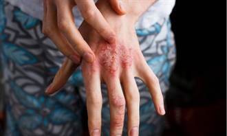 異位性皮膚炎沒發作不代表病好了  必知不發病的黃金定律