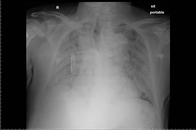 該男子的肺部因染疫，呈現整片白色。（圖／翻攝自柯世祐臉書）