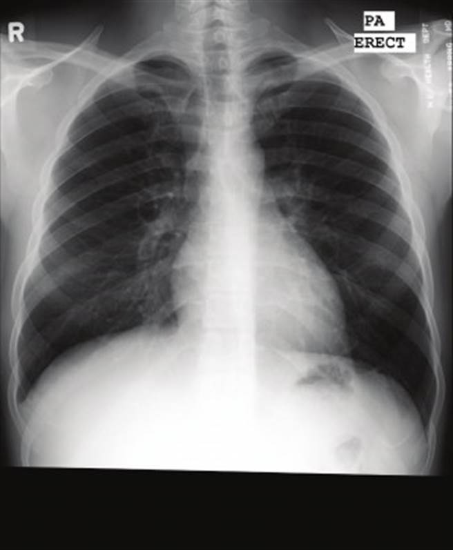 正常未染疫的肺部。（圖／翻攝自柯世祐臉書）