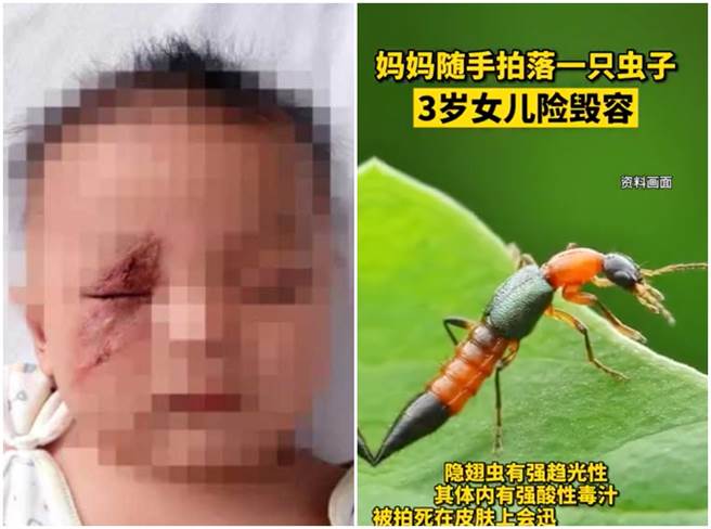 女童的脸因被隐翅虫的毒液沾到，因此出现巨大的伤疤。（图／微博＠星星片场）
