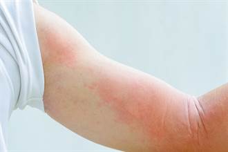 蕁麻疹全身癢爆怎辦？ 皮膚科醫認證「7大止癢攻略」