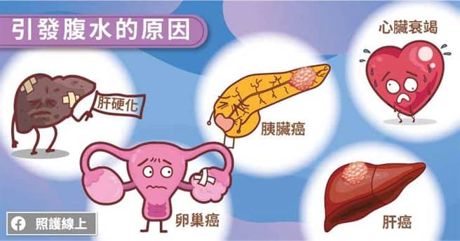 引发腹水的可能原因。(图/照护线上提供)