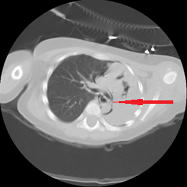 胸部电脑断层检查发现男童主气管与左支气管交接处有异物。（中国医药大学儿童医院提供）