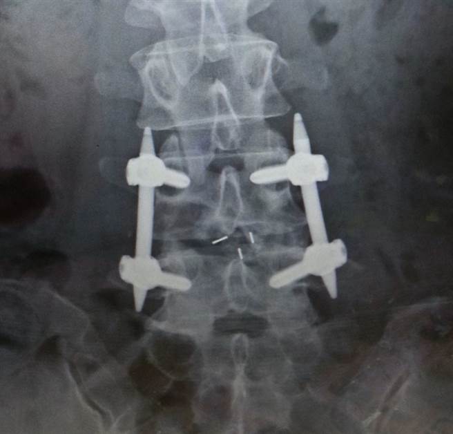 腰椎大部分有五节骨头，骨头之间有做为缓街的椎间盘。（景美医院提供）