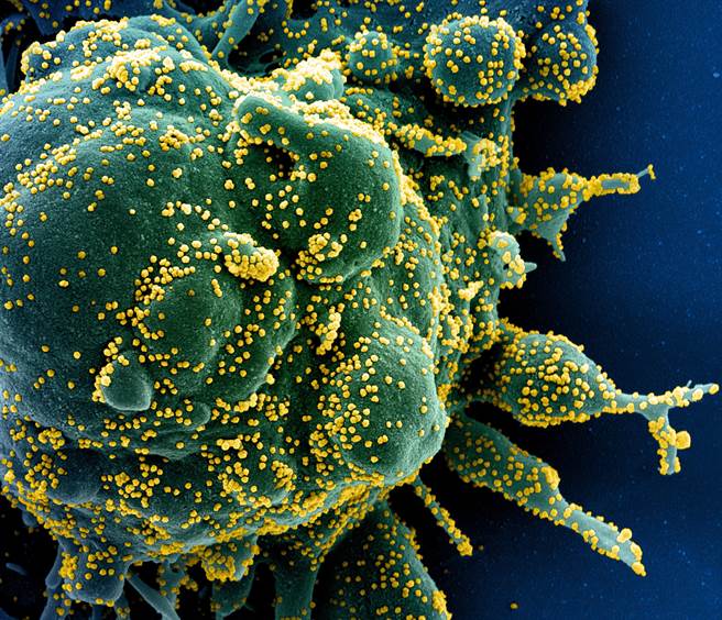 最新研究認為，新冠病毒會誤導患者的免疫系統，讓抗體去攻擊自己的組織器官。圖為新冠病毒攻擊人體細胞電子顯微鏡照片。（圖／路透）