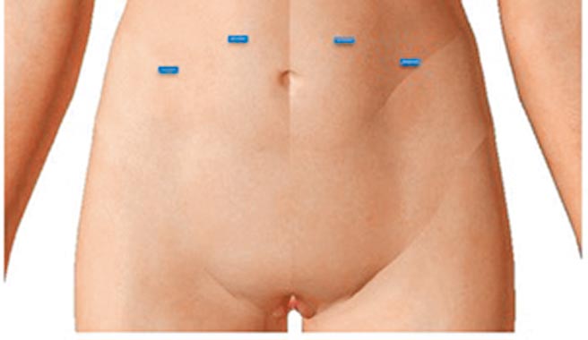 利用腹腔鏡或達文西機器手臂系統進行內視鏡微創手術，只會有3到4個1公分以下小傷口。（國泰醫院提供）