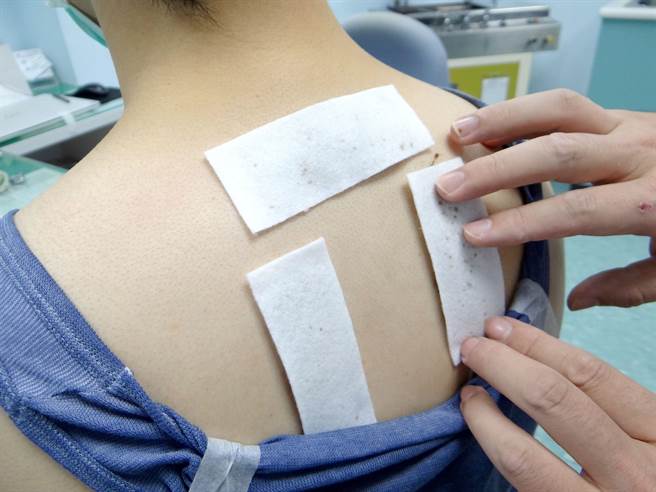 奇美醫學中心中醫部總醫師蕭坤元示範三伏貼。(奇美醫學中心提供／曹婷婷台南傳真)