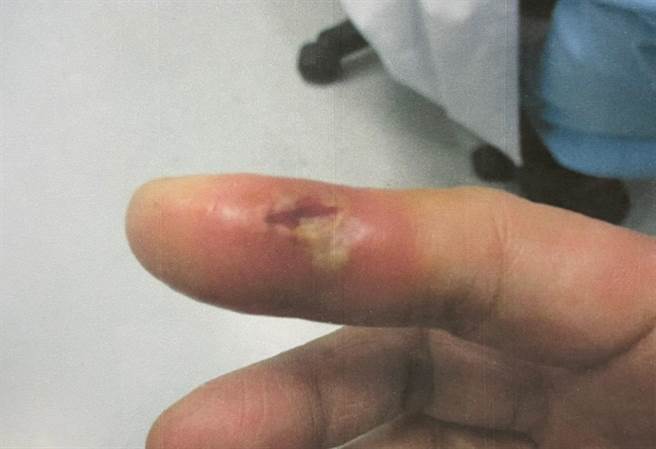 台中市60陳姓女患者被魚刺刺傷，小傷口卻引發蜂窩性組織炎。（台中醫院提供／張妍溱台中傳真）