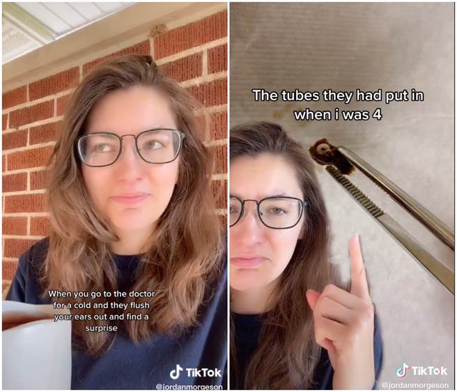 女网友去医院检查才发现小时候治疗中耳炎的导管，竟卡在她的耳朵中22年。（图／TikTok＠dogs_over_ppl）