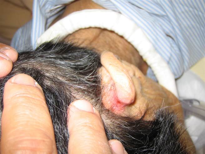 松紧带造成耳上发红破皮。(奇美医学中心提供／曹婷婷台南传真)