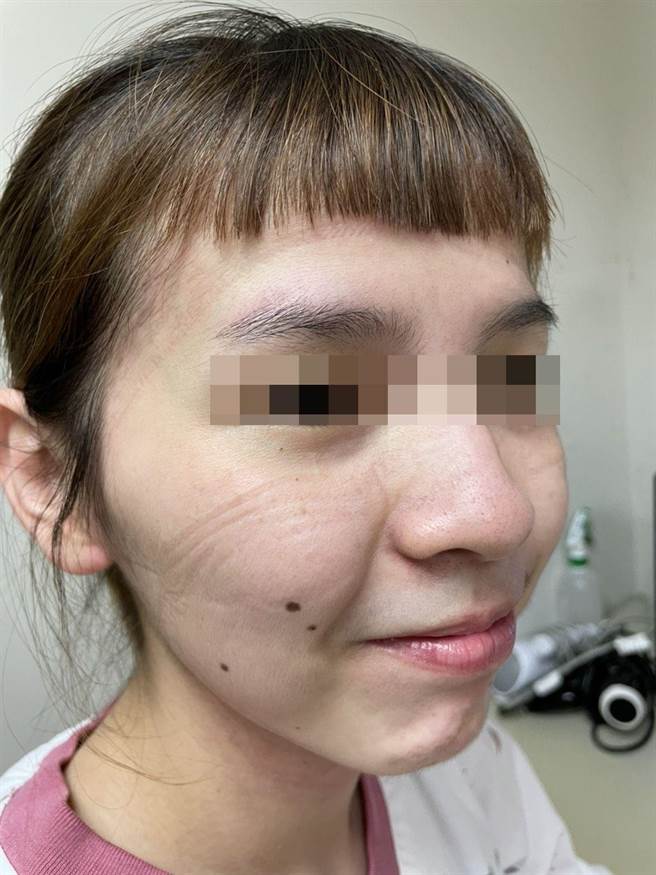 口罩、护目镜卸除后的额头、脸颊压痕。(奇美医学中心提供／曹婷婷台南传真)