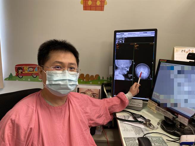 長安醫院小兒科主任陳震南指出，經X光檢查兩歲男童有一顆鈕釦電池卡在鼻孔裡面。（長安醫院提供／馮惠宜台中傳真）