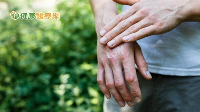 乾癣是一种全身发炎的自体免疫疾病，不只皮肤发炎，更会引发身体多种併发症，增加冠状动脉心臟病、脑中风等心血管共病的死亡率。(图/健康医疗网提供)