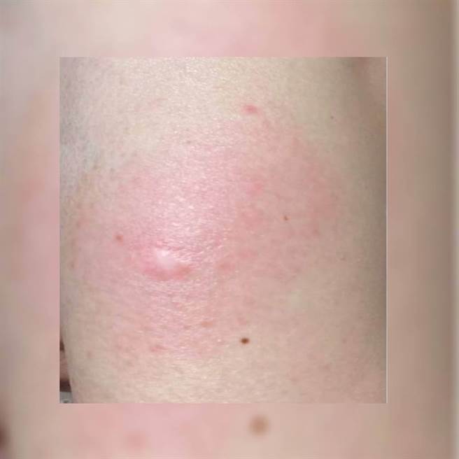 新冠手臂正式名称是「延迟性大型局部反应」，施打疫苗的部位可能出现红肿灼热的肿包。(图/书田诊所提供)