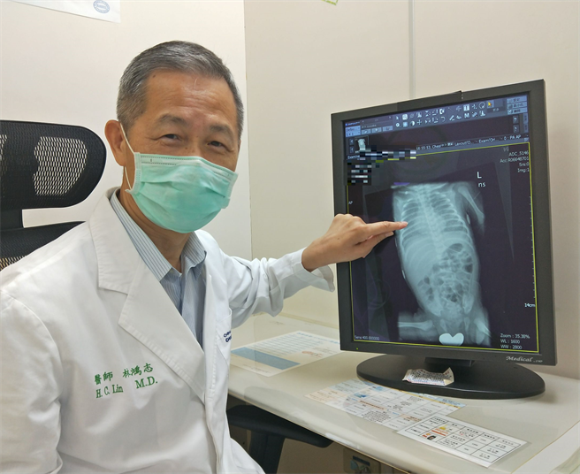 林鸿志指出，检查发现李小妹是因罕见的「先天表面张力素蛋白质的制造缺乏」才造成呼吸困难。（中国附医提供／张妍溱台中传真）