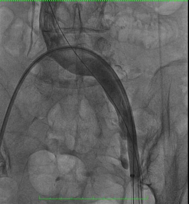 85岁李姓阿嬷术后血管摄影发现左侧髂静脉以及左股静脉血栓已清除，血液回流良好。