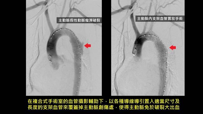在复合式手术室的血管摄影辅助下，以各种导线导引置入适当尺寸及长度的支架血管来覆盖掉主动脉创伤处，使得主动脉免于破裂大出血。(奇美医学中心提供／曹婷婷台南传真)