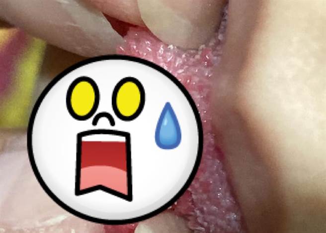 侄女爱咬头髮，突然哭喊舌头痛，拿放大镜检查才发现一根头髮缠在舌乳头上了。（图／翻摄自爆废公社二馆） 