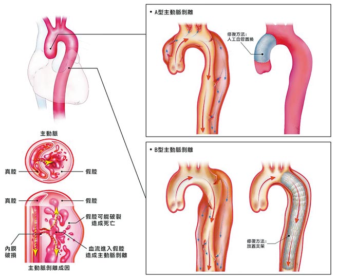 主动脉剥离是猝死常见原因，国内每年约有近2000人发病。（长庚医院提供）