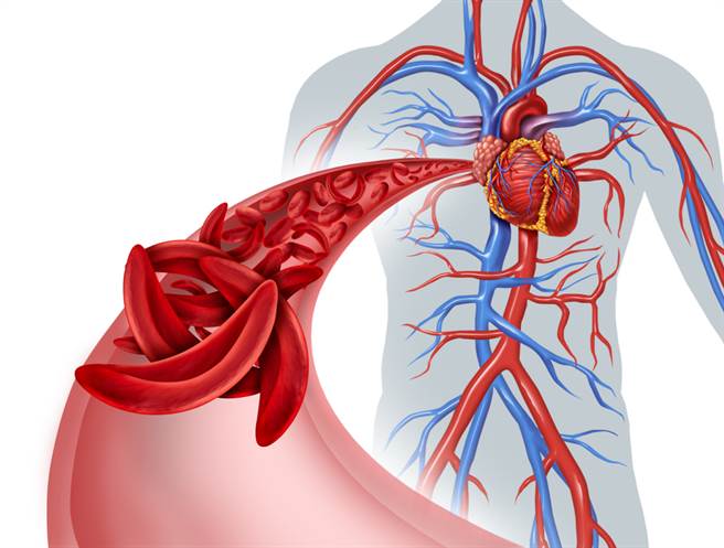 心臟零件出状况！经导管主动脉瓣膜置换免开心。(示意图/Shutterstock)