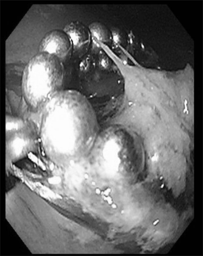 12岁男童，因把玩益智玩具时误吞32颗磁力球，腹部X光显示胃部有环状磁珠。（中国医药大学儿童医院提供／张妍溱台中传真）