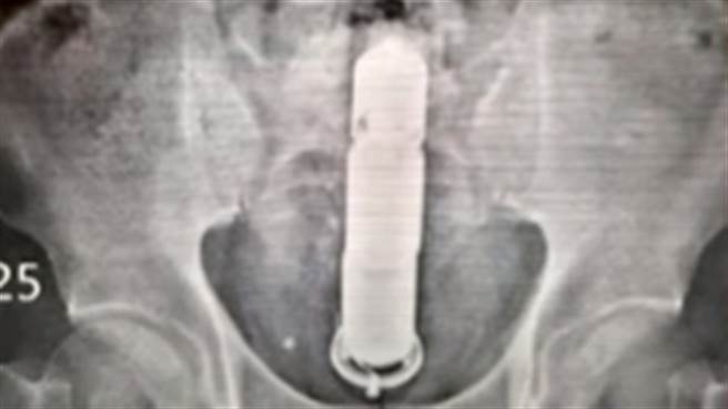 一对夫妻因疫情间为增加彼此间感情，太太竟将30公分按摩棒塞入先生屁股，拔不出只好到医院急诊室就医。（图／翻摄自医师好辣YouTube）