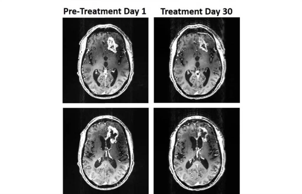 经过30天的强力磁化治疗，脑肿瘤明显缩小。(图/Houston Methodist Hospital)(photo:ChinaTimes)
