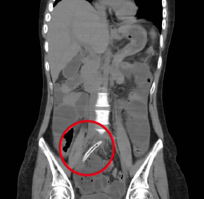 经电脑断层检查后发现，在迴肠与结肠交界的部位有4公分的牙籤造成肠穿孔与脓疡。（台中医院提供／张妍溱台中传真）
