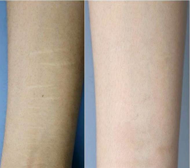 整形名医曹赐斌《白疤顏色再生术》使用头皮取出的自体显微色素皮粒，淡疤率再提升2成，能有效消去割腕造成的白疤。（曹赐斌提供／袁庭尧高雄传真）