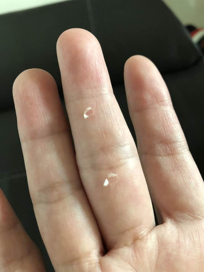 童医院护理人员手部破皮。(童医院提供)