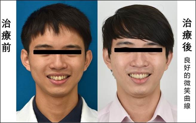 實際病患配戴隱形牙套治療的前後比較(圖/臺北榮總提供)