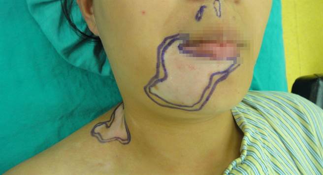22歲少女右下唇白斑症發作，常被誤會嘴角有冰淇淋而深受困擾。（光田醫院提供／王文吉台中傳真）